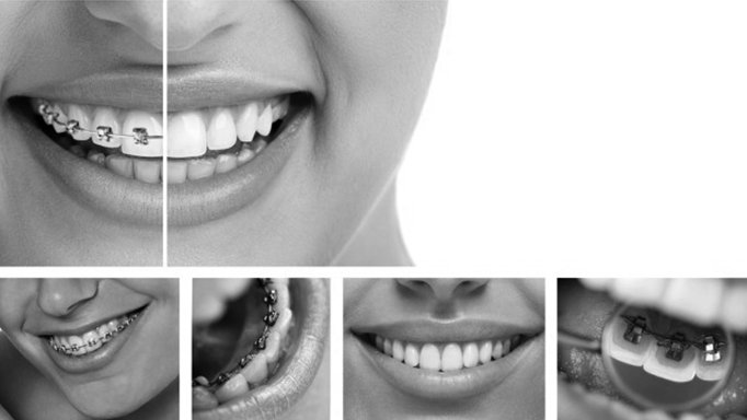 Higiene bucal en personas que llevan ortodoncia
