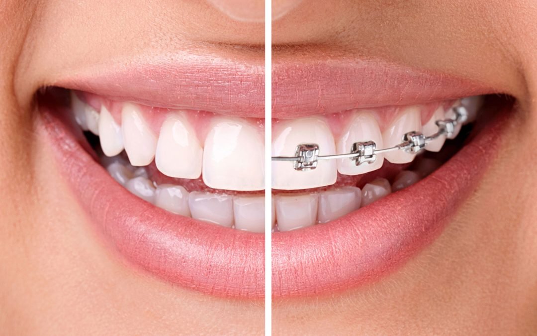 Las 7 fases o etapas de la ortodoncia