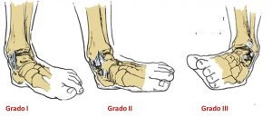 ortopedistas en cancun deformaciones del pie