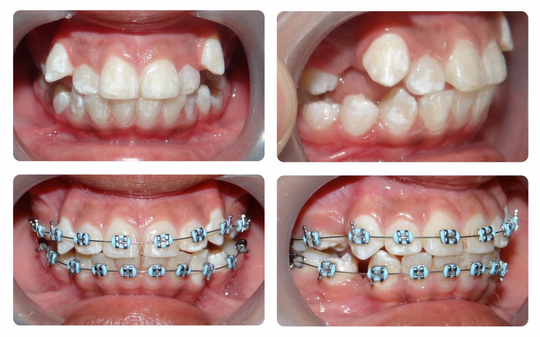 Tipos de tratamientos de ortodoncia