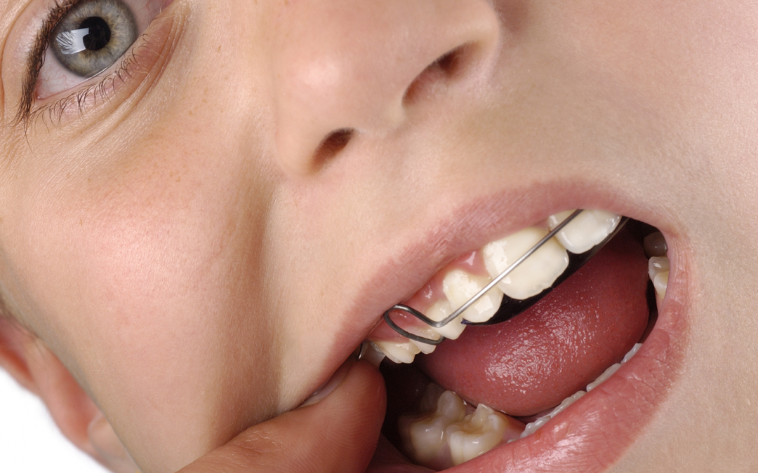 ¿Para qué sirve el paladar en la ortodoncia?