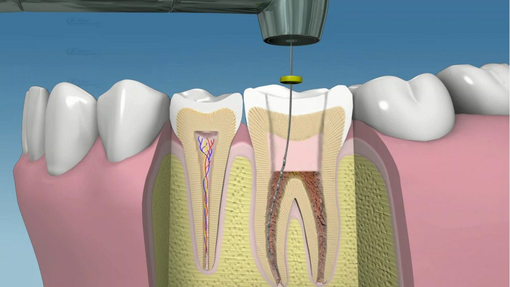 endodoncia-en cancun