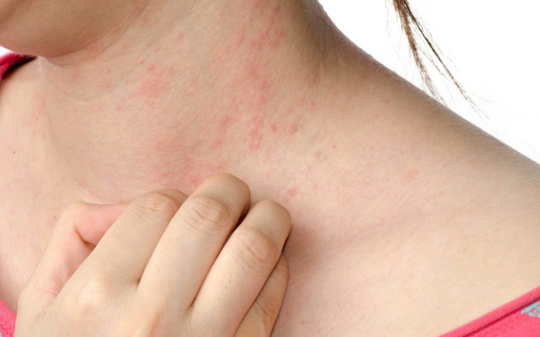 Tipos de infecciones en la piel