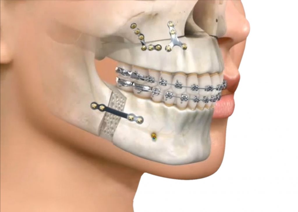 maxilofacial en cancun