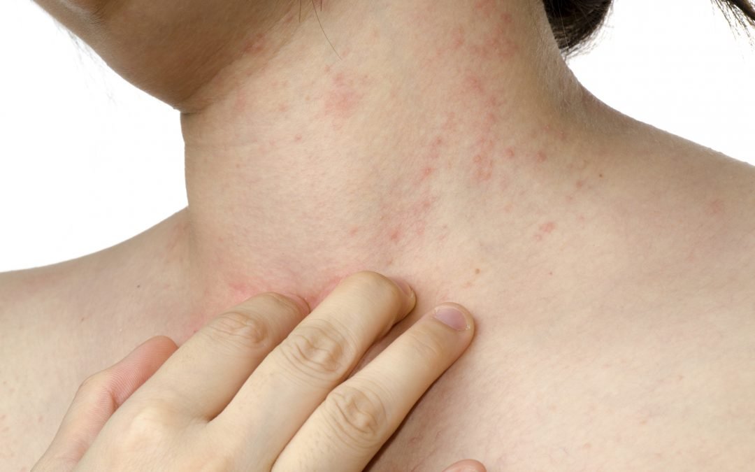 Tipos de alergias en la piel