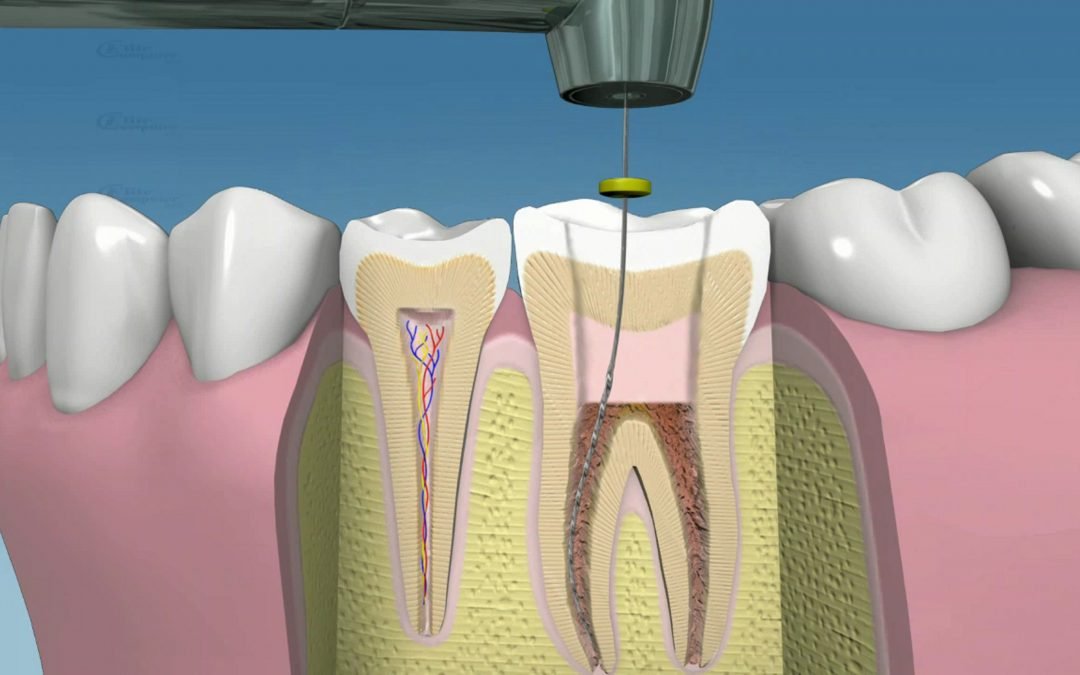 ¿Cómo se hace una endodoncia?