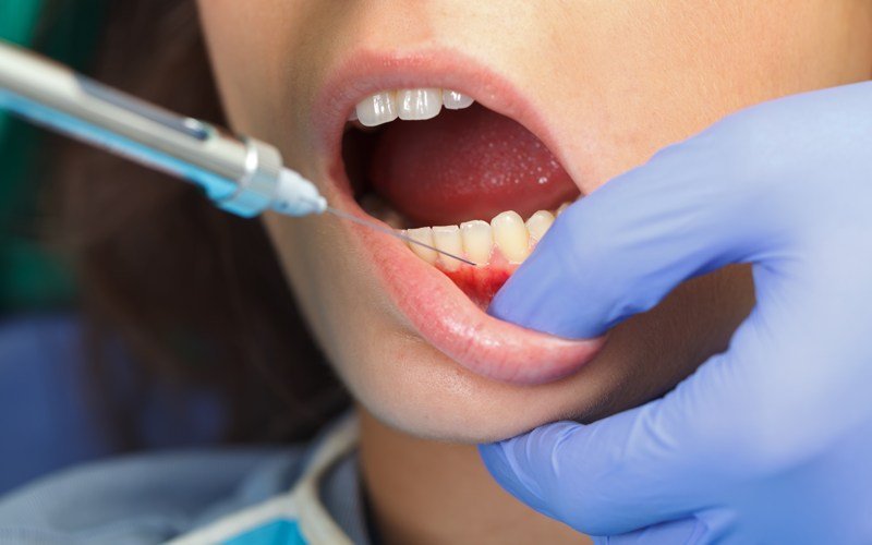 Efectos secundarios de la anestesia dental